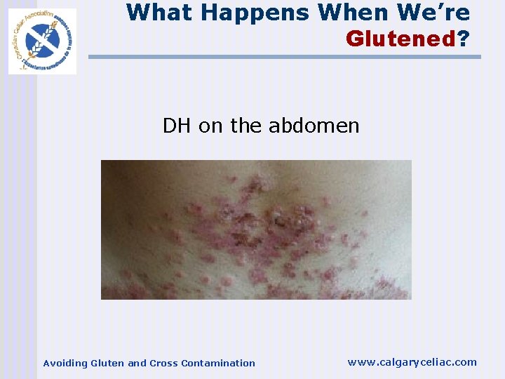 What Happens When We’re Glutened? DH on the abdomen Avoiding Gluten and Cross Contamination