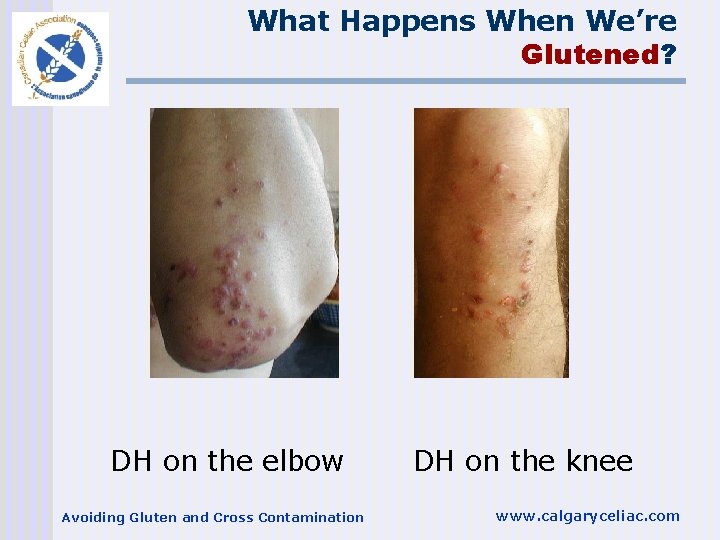 What Happens When We’re Glutened? DH on the elbow Avoiding Gluten and Cross Contamination