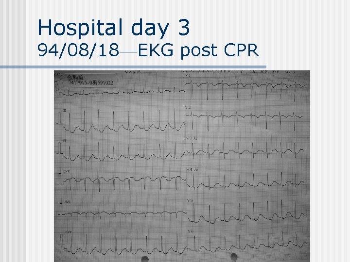 Hospital day 3 94/08/18—EKG post CPR 