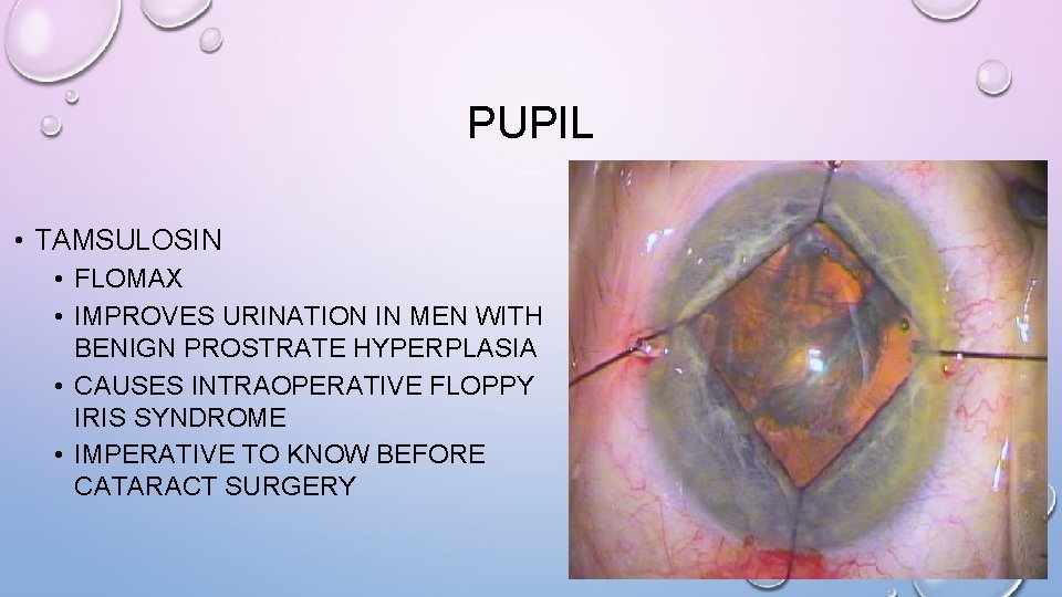 PUPIL • TAMSULOSIN • FLOMAX • IMPROVES URINATION IN MEN WITH BENIGN PROSTRATE HYPERPLASIA