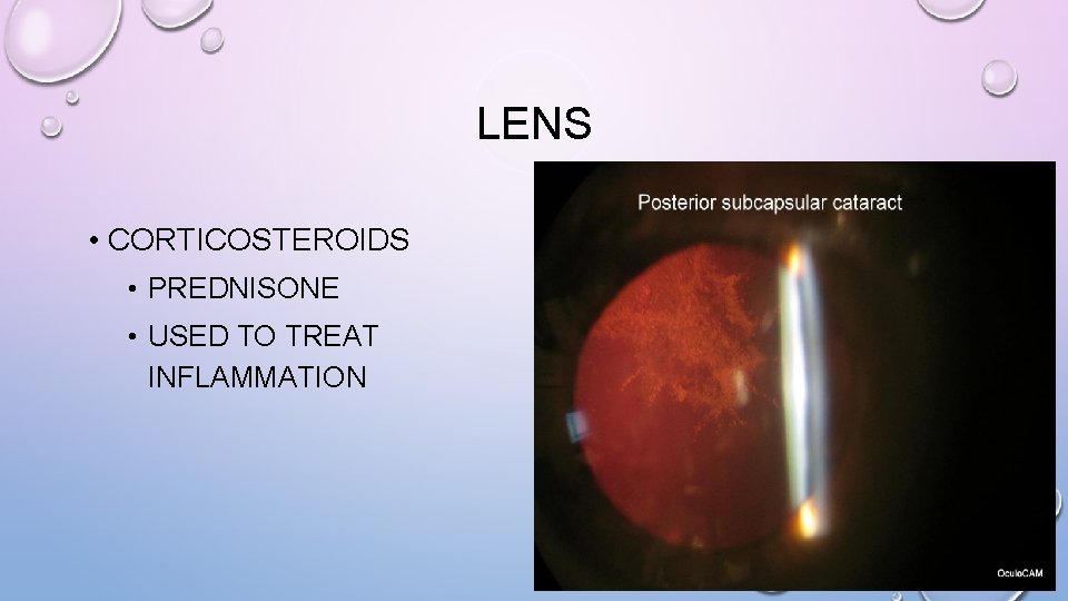 LENS • CORTICOSTEROIDS • PREDNISONE • USED TO TREAT INFLAMMATION 