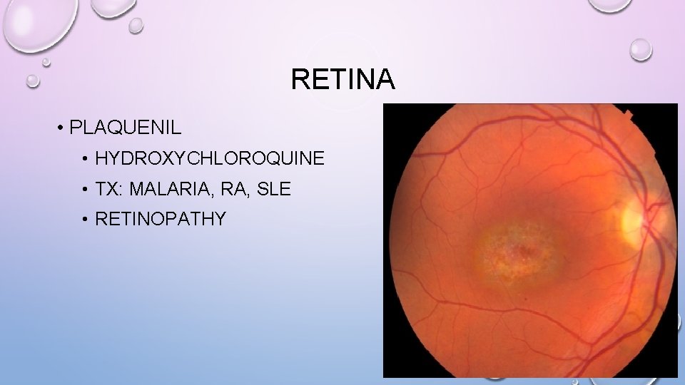 RETINA • PLAQUENIL • HYDROXYCHLOROQUINE • TX: MALARIA, RA, SLE • RETINOPATHY 