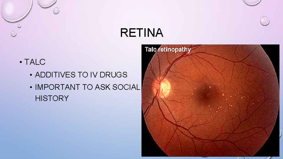 RETINA • TALC • ADDITIVES TO IV DRUGS • IMPORTANT TO ASK SOCIAL HISTORY