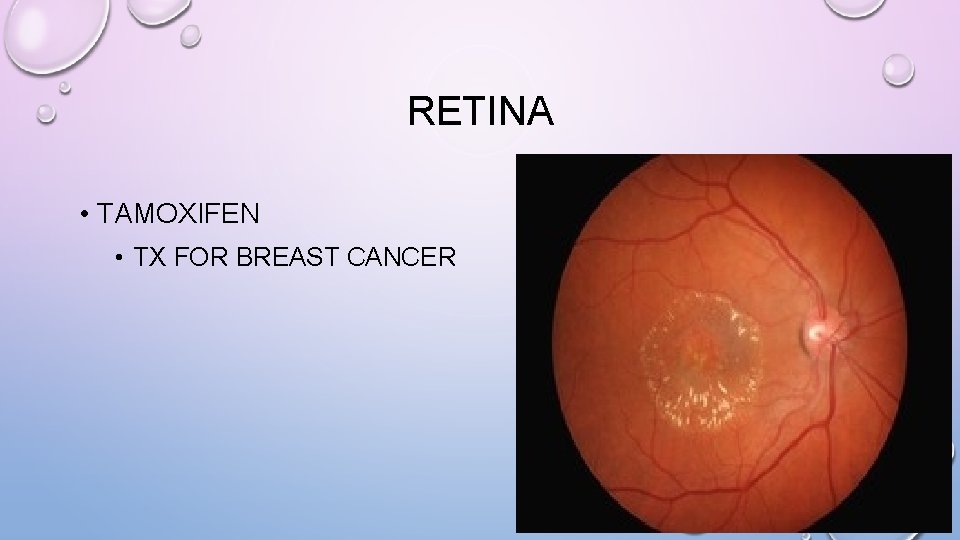 RETINA • TAMOXIFEN • TX FOR BREAST CANCER 