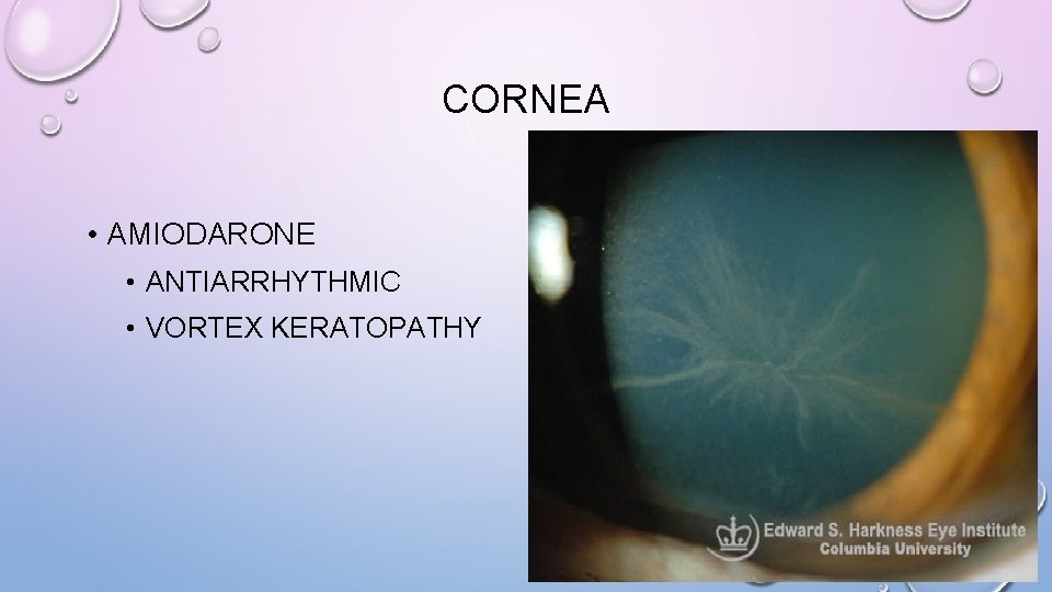 CORNEA • AMIODARONE • ANTIARRHYTHMIC • VORTEX KERATOPATHY 