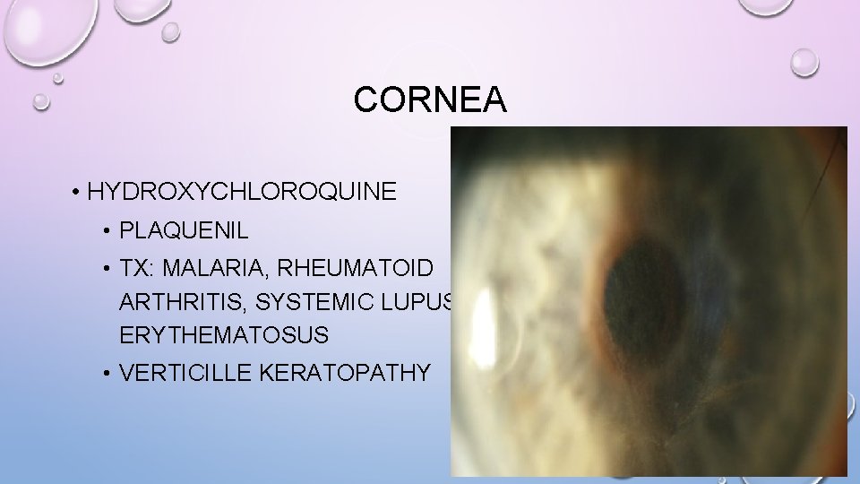 CORNEA • HYDROXYCHLOROQUINE • PLAQUENIL • TX: MALARIA, RHEUMATOID ARTHRITIS, SYSTEMIC LUPUS ERYTHEMATOSUS •