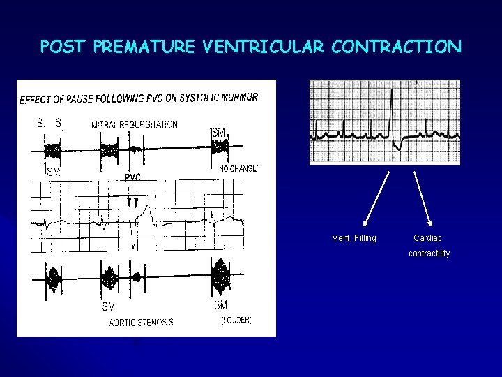POST PREMATURE VENTRICULAR CONTRACTION Vent. Filling Cardiac contractility POST PREMATURE VENTRICULAR CONTRACTION Vent. Filling Cardiac contractility
