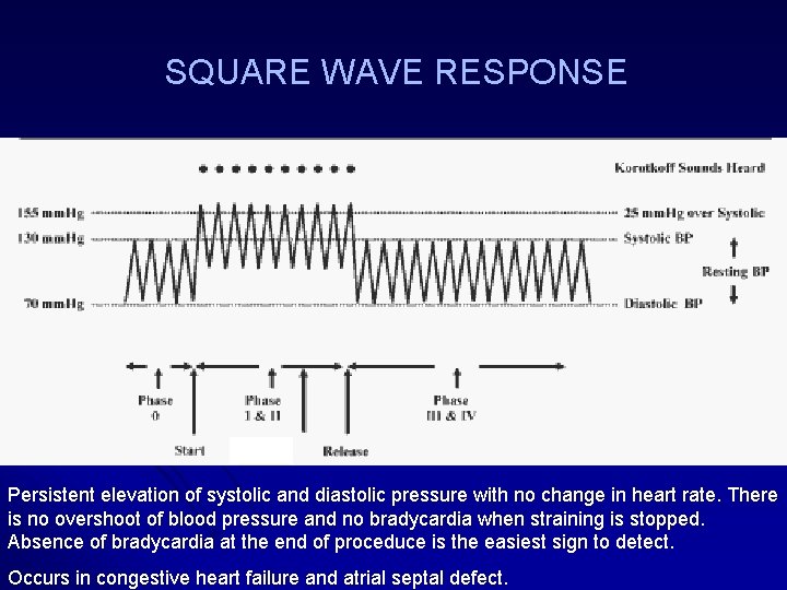 SQUARE WAVE RESPONSE Persistent elevation of systolic and diastolic pressure with no change in SQUARE WAVE RESPONSE Persistent elevation of systolic and diastolic pressure with no change in