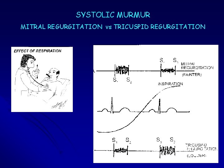 SYSTOLIC MURMUR MITRAL REGURGITATION vs TRICUSPID REGURGITATION SYSTOLIC MURMUR MITRAL REGURGITATION vs TRICUSPID REGURGITATION