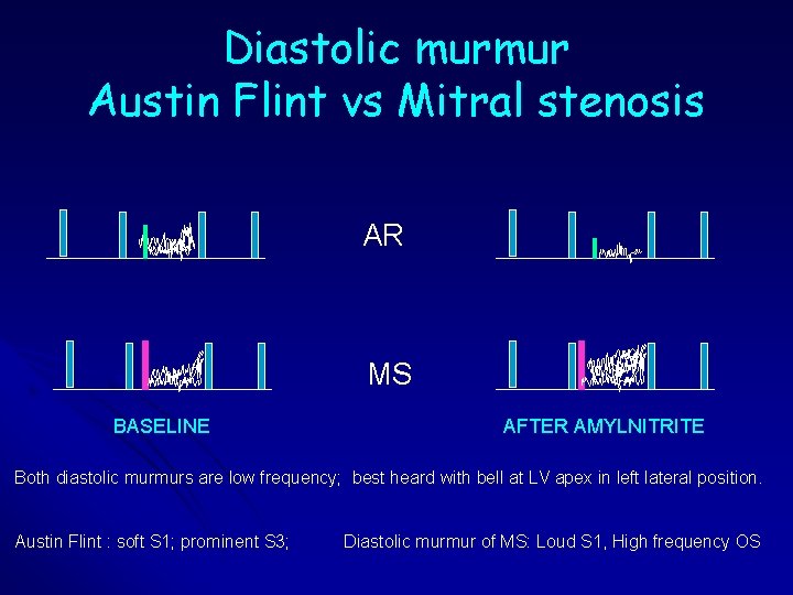 Diastolic murmur Austin Flint vs Mitral stenosis AR MS BASELINE AFTER AMYLNITRITE Both diastolic Diastolic murmur Austin Flint vs Mitral stenosis AR MS BASELINE AFTER AMYLNITRITE Both diastolic