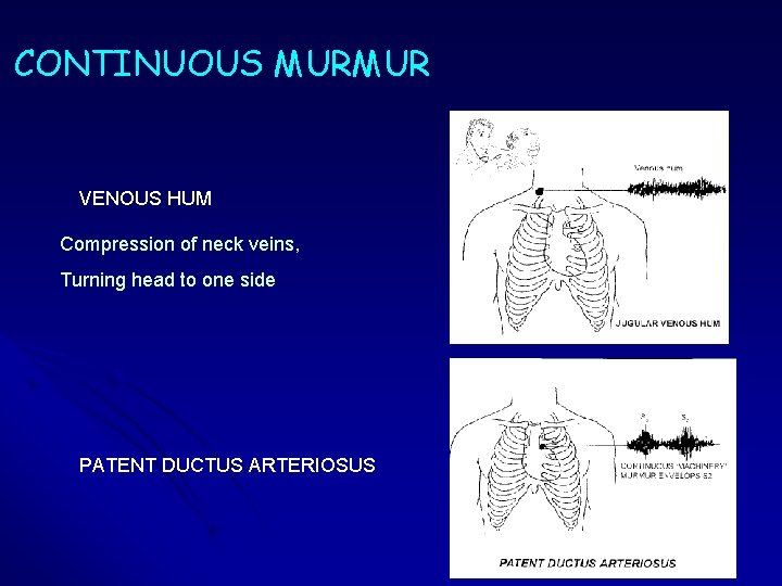 CONTINUOUS MURMUR VENOUS HUM Compression of neck veins, Turning head to one side PATENT CONTINUOUS MURMUR VENOUS HUM Compression of neck veins, Turning head to one side PATENT