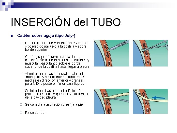 INSERCIÓN del TUBO n Catéter sobre aguja (tipo Joly®): ¨ Con un bisturí hacer