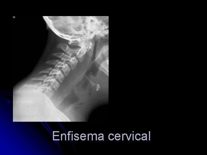 Enfisema cervical 