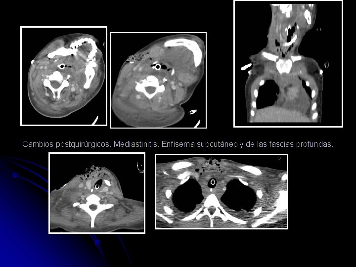 Cambios postquirúrgicos. Mediastinitis. Enfisema subcutáneo y de las fascias profundas. 