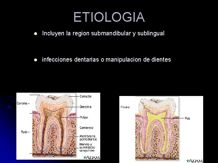 ETIOLOGIA l Incluyen la region submandibular y sublingual l infecciones dentarias o manipulacion de