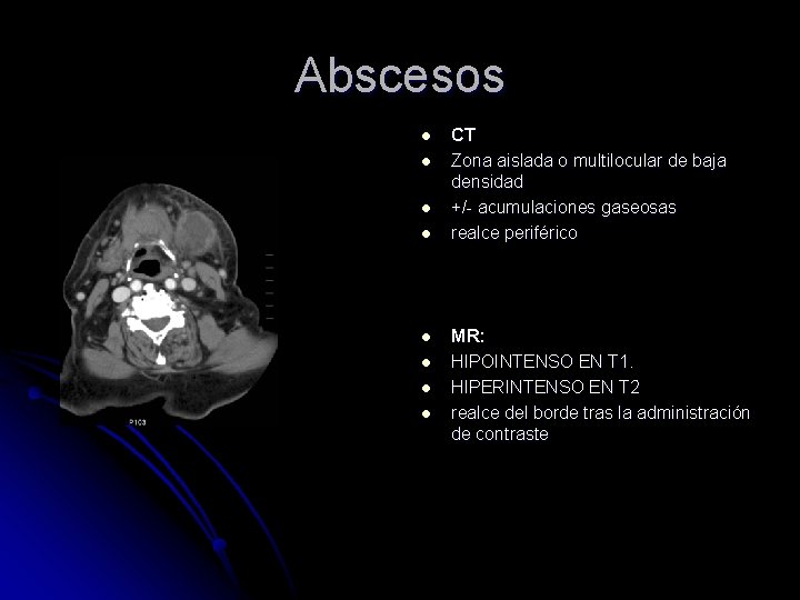 Abscesos l l l l CT Zona aislada o multilocular de baja densidad +/-