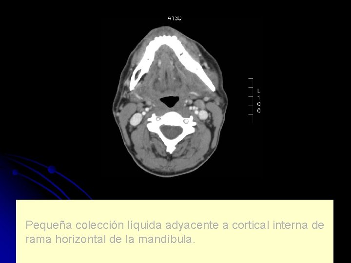 Pequeña colección líquida adyacente a cortical interna de rama horizontal de la mandíbula. 