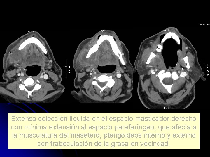 Extensa colección líquida en el espacio masticador derecho con mínima extensión al espacio parafaríngeo,