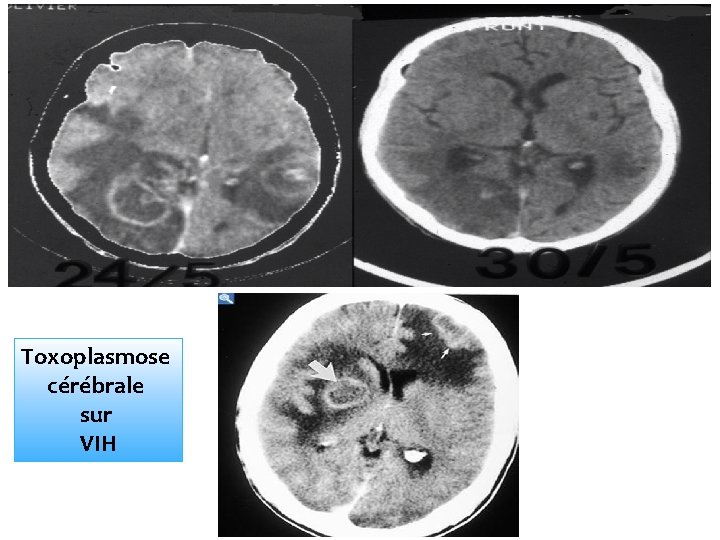 Toxoplasmose cérébrale sur VIH 