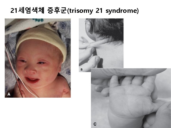 21세염색체 증후군(trisomy 21 syndrome) 