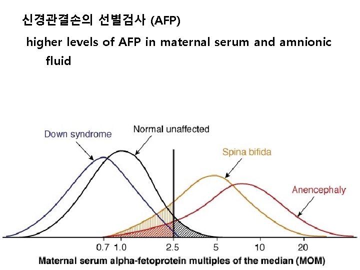 신경관결손의 선별검사 (AFP) higher levels of AFP in maternal serum and amnionic fluid 