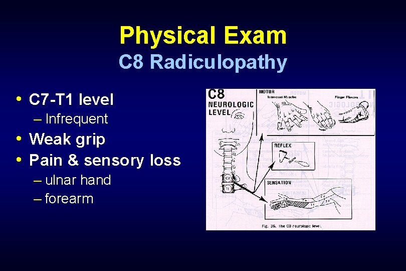 Physical Exam C 8 Radiculopathy • C 7 -T 1 level – Infrequent •