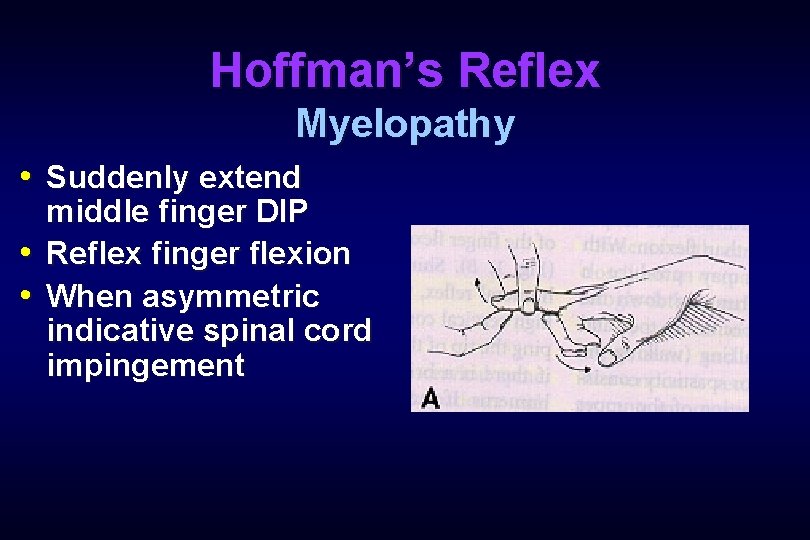 Hoffman’s Reflex Myelopathy • Suddenly extend middle finger DIP • Reflex finger flexion •