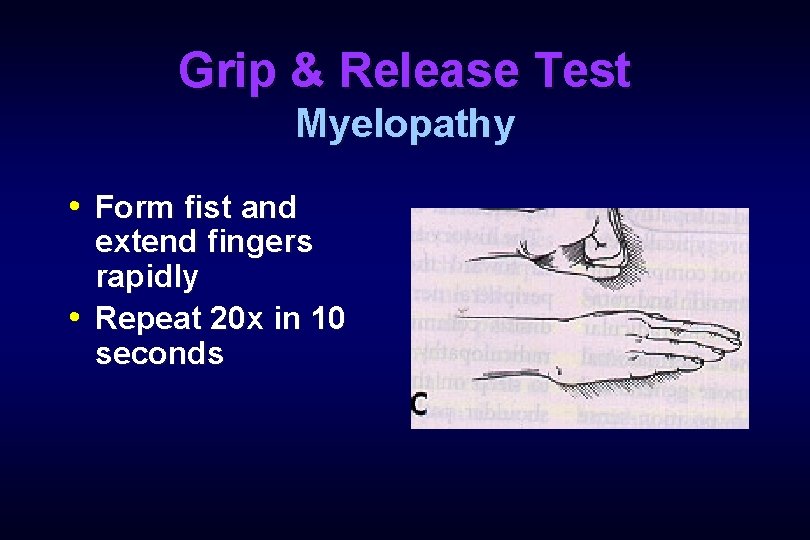 Grip & Release Test Myelopathy • Form fist and extend fingers rapidly • Repeat