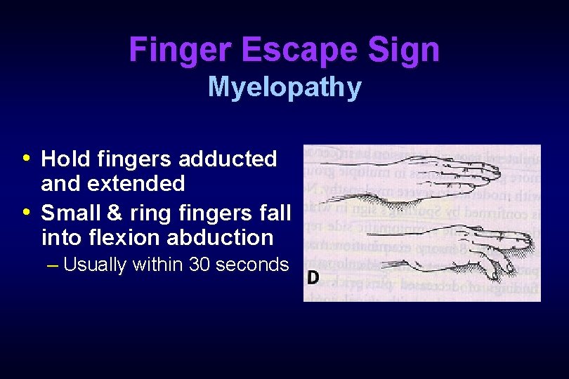 Finger Escape Sign Myelopathy • Hold fingers adducted and extended • Small & ring