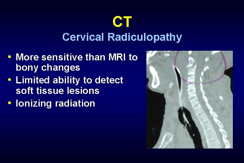 CT Cervical Radiculopathy • More sensitive than MRI to bony changes • Limited ability