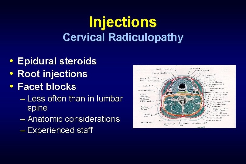 Injections Cervical Radiculopathy • • • Epidural steroids Root injections Facet blocks – Less