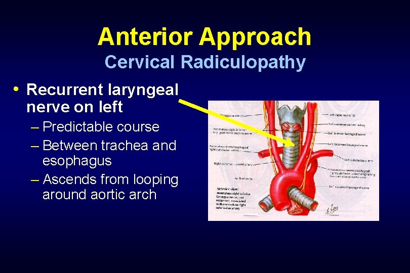 Anterior Approach Cervical Radiculopathy • Recurrent laryngeal nerve on left – Predictable course –