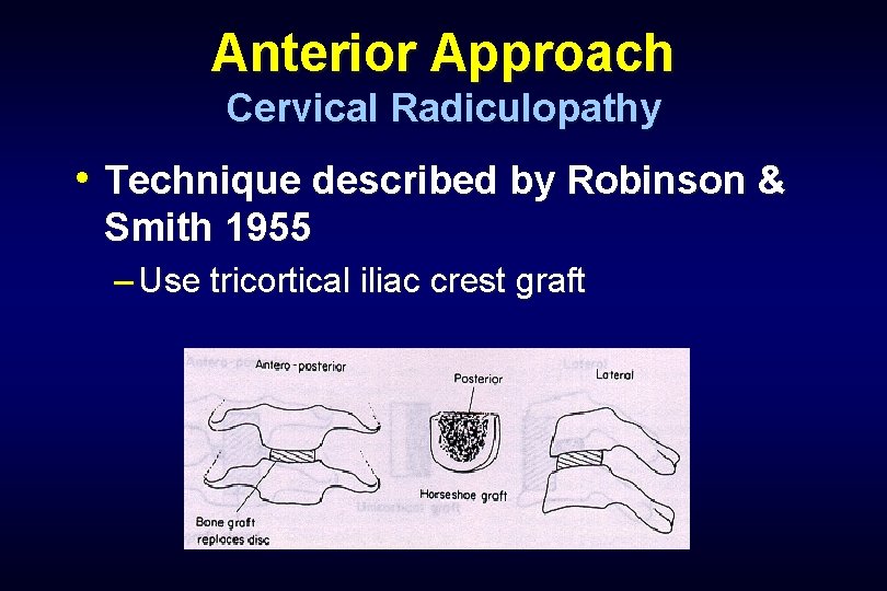 Anterior Approach Cervical Radiculopathy • Technique described by Robinson & Smith 1955 – Use