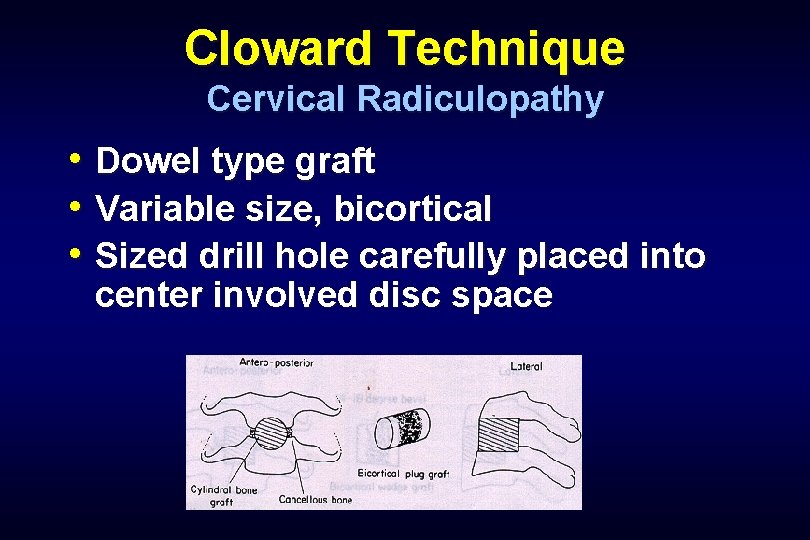 Cloward Technique Cervical Radiculopathy • Dowel type graft • Variable size, bicortical • Sized