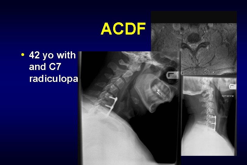 ACDF • 42 yo with both C 6 and C 7 radiculopathy 