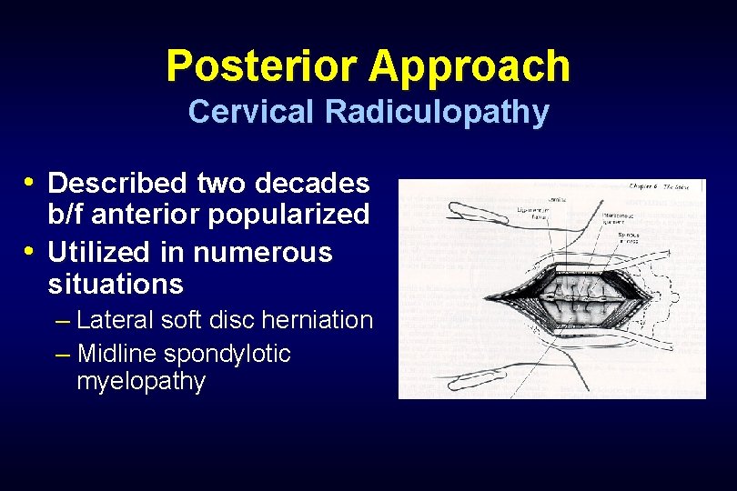 Posterior Approach Cervical Radiculopathy • Described two decades b/f anterior popularized • Utilized in