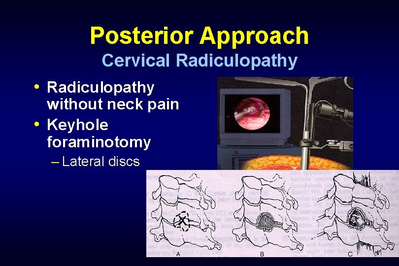 Posterior Approach Cervical Radiculopathy • Radiculopathy without neck pain • Keyhole foraminotomy – Lateral