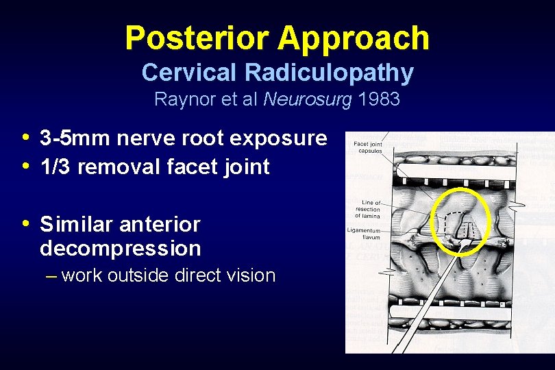 Posterior Approach Cervical Radiculopathy Raynor et al Neurosurg 1983 • 3 -5 mm nerve