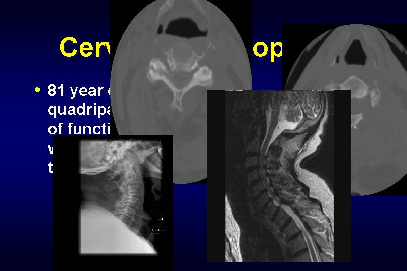 Cervical Laminoplasty • 81 year old with quadriparesis, loss of function of all 4,