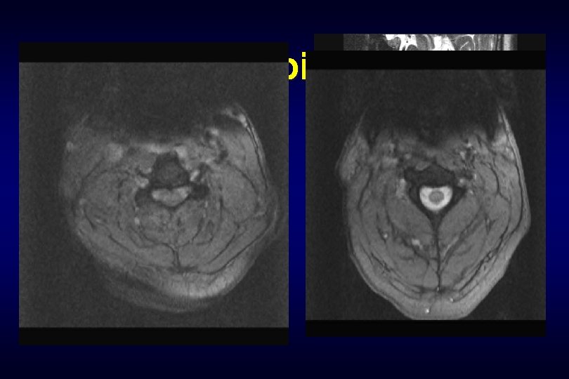 Combined • 42 year old with progressive quadriplegia in the ER 