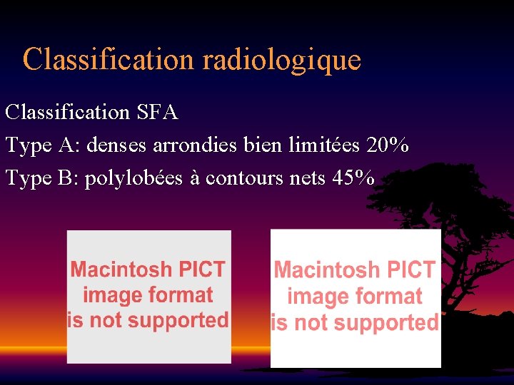 Classification radiologique Classification SFA Type A: denses arrondies bien limitées 20% Type B: polylobées