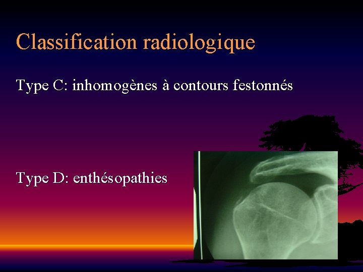 Classification radiologique Type C: inhomogènes à contours festonnés Type D: enthésopathies 