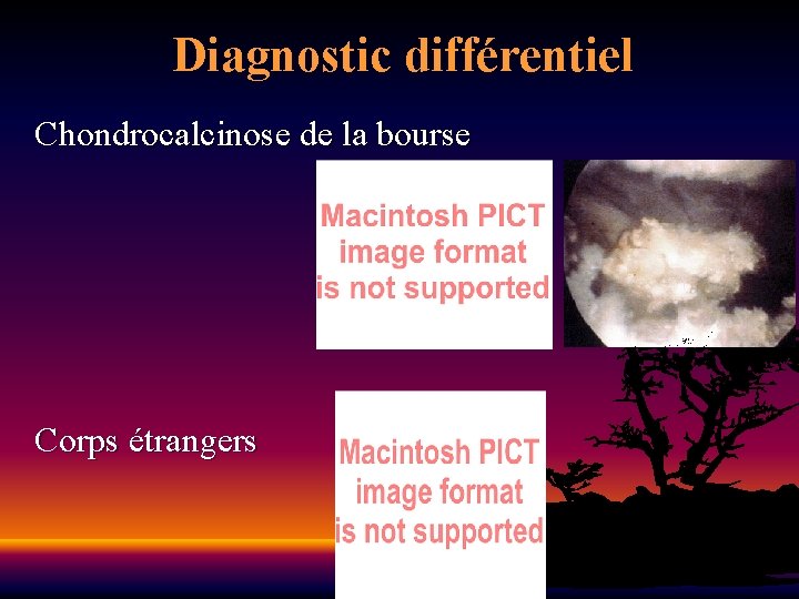 Diagnostic différentiel Chondrocalcinose de la bourse Corps étrangers 