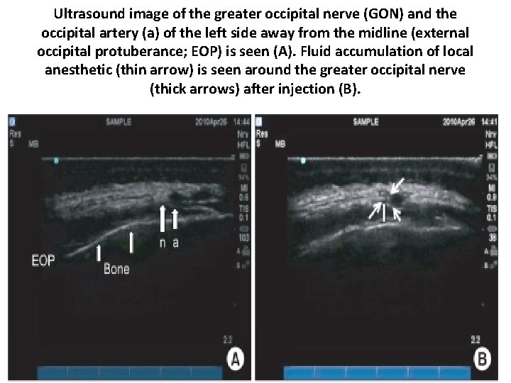 Ultrasound image of the greater occipital nerve (GON) and the occipital artery (a) of