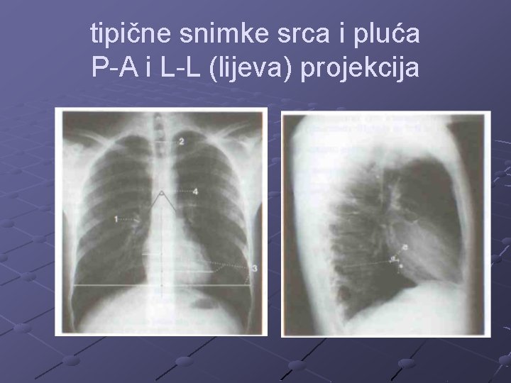 tipične snimke srca i pluća P-A i L-L (lijeva) projekcija 
