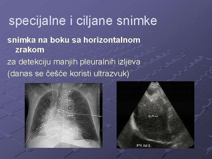 specijalne i ciljane snimka na boku sa horizontalnom zrakom za detekciju manjih pleuralnih izljeva