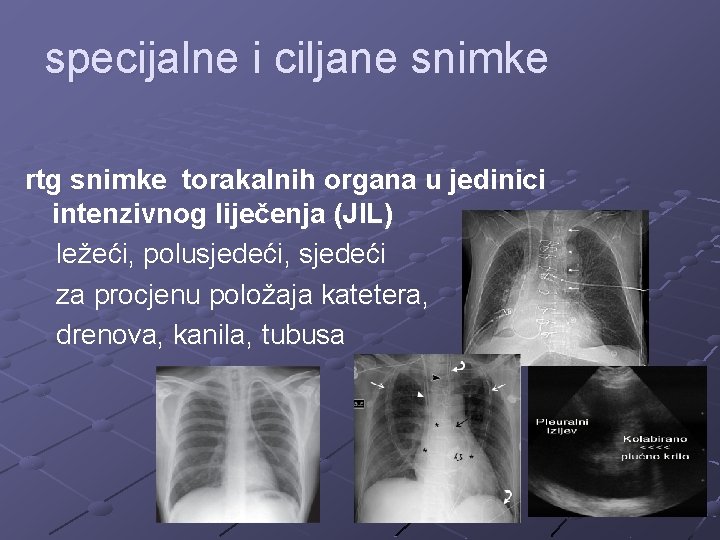specijalne i ciljane snimke rtg snimke torakalnih organa u jedinici intenzivnog liječenja (JIL) ležeći,