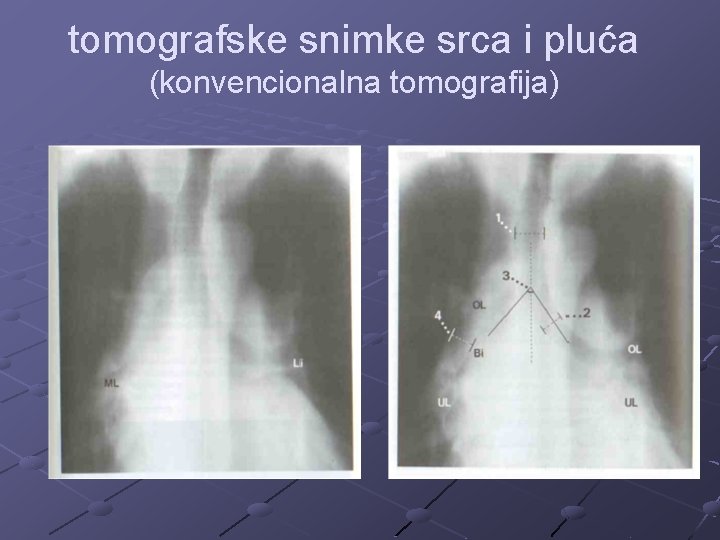 tomografske snimke srca i pluća (konvencionalna tomografija) 