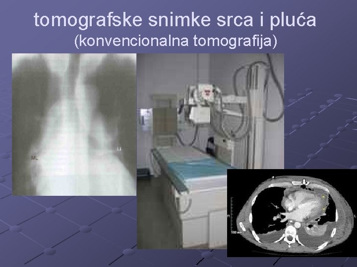 tomografske snimke srca i pluća (konvencionalna tomografija) 