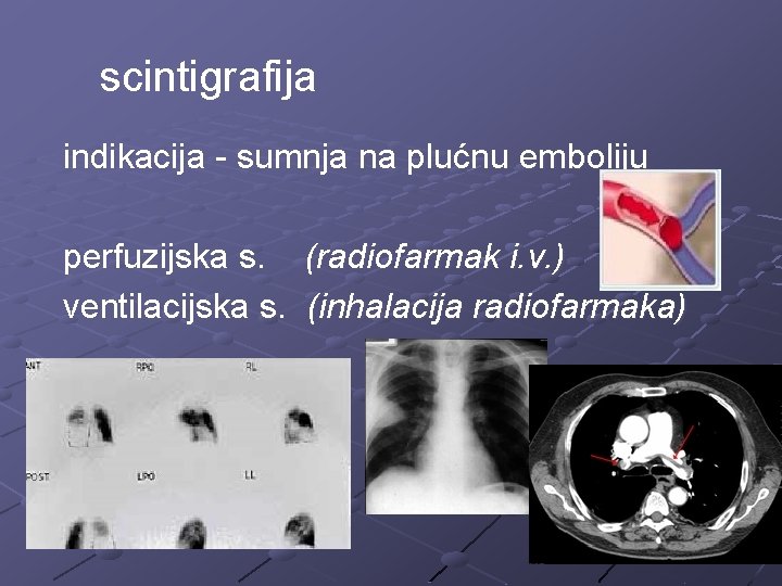 scintigrafija indikacija - sumnja na plućnu emboliju perfuzijska s. (radiofarmak i. v. ) ventilacijska